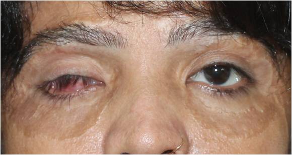 Ocular Prosthesis Delhi India